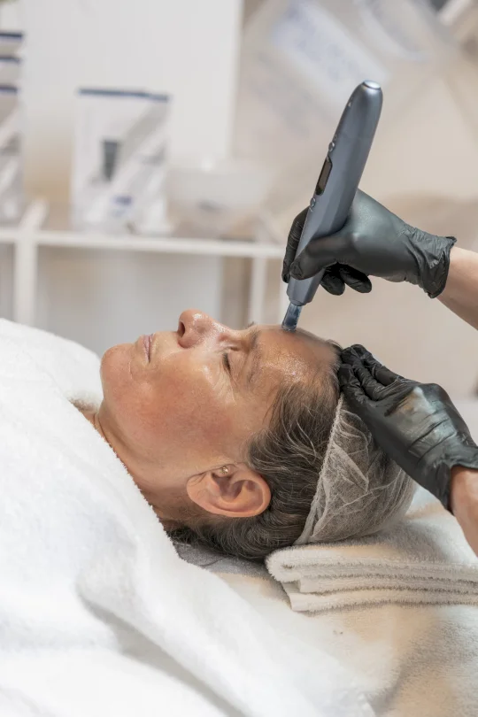 Micro-Needling behandling